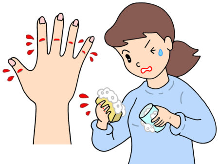 亀裂性湿疹,あかぎれ,ひび割れ,皮膚疾患,出血,痛み,手湿疹,乾燥肌,亀裂,食器洗い,水仕事